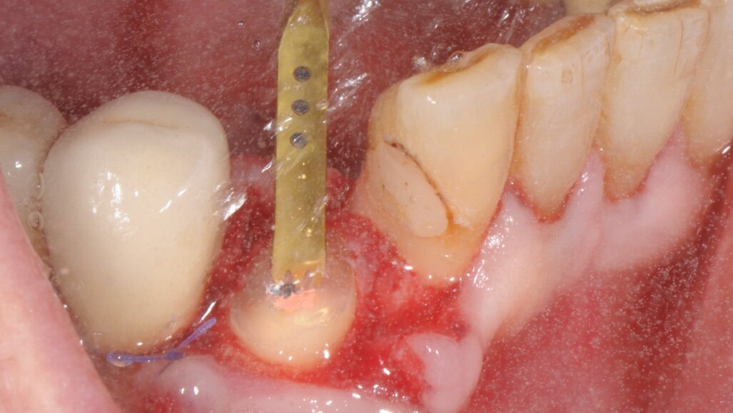 Impianto post-estrattivo e sua protesizzazione immediata. La tecnica di preparazione endo-alveolare del sito implantare con PIEZOSURGERY