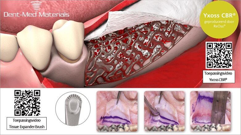 Complexe botdefecten, weefseltoename en spanningsvrij hechten