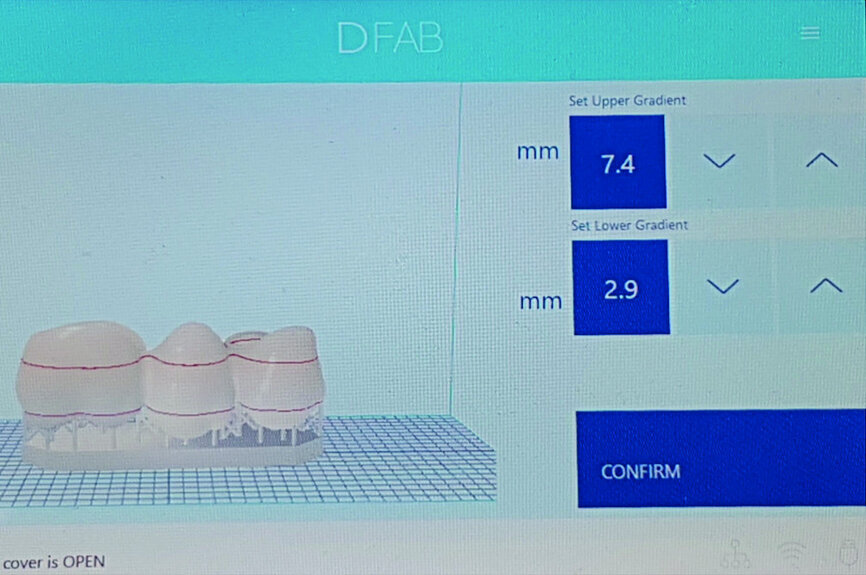Fig. 22: Choice of shade and position of the graduation for a three-unit posterior bridge.