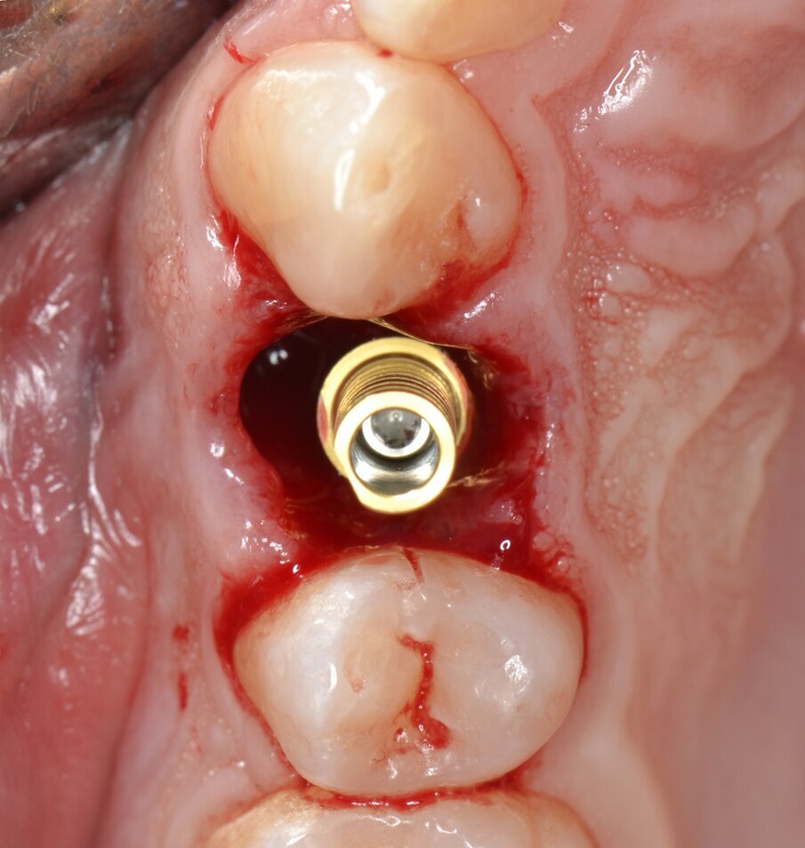 Fig. 11 - Moncone provvisorio serrato a 35 N.cm.