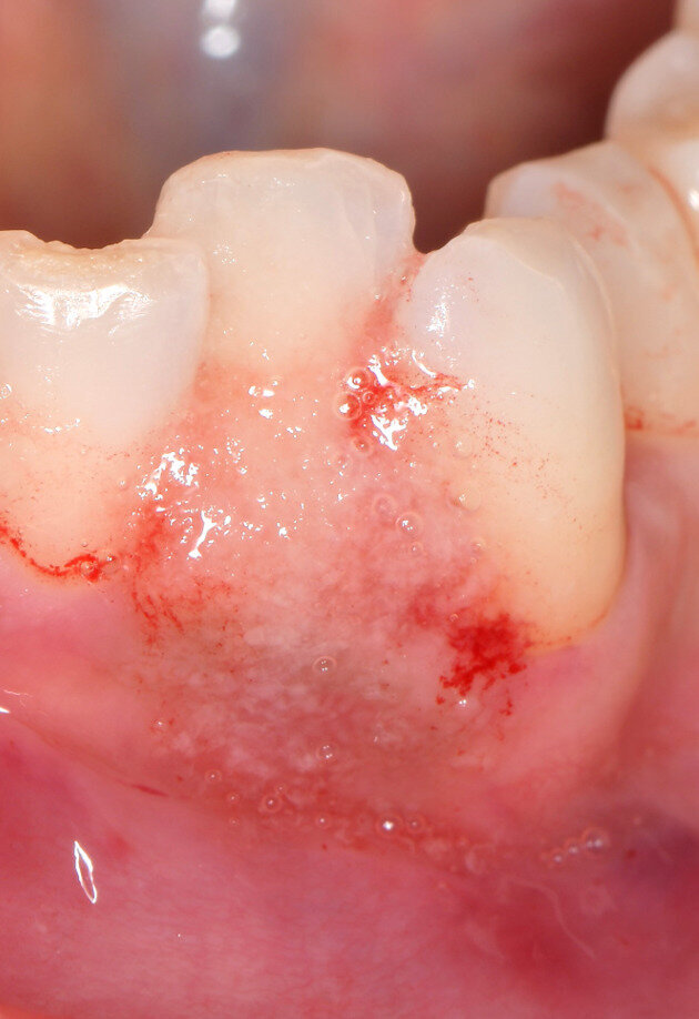 Fig. 5 - Fase di setting del prodotto H42. Il sito deve essere tenuto asciutto per 5 minuti dopo l’applicazione di H42 per favorirne l’adesione ai tessuti. Il prodotto è messo a colmare completamente la tasca, fino a uscirne.