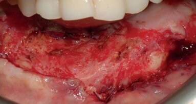 Подготовка на периимплантните меки тъкани при пациенти с реконструкция със свободно ламбо от фибула