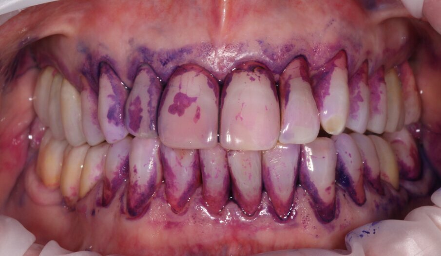 Figg. 5a, 5b - Miglioramento del FMPS a 8 settimane.