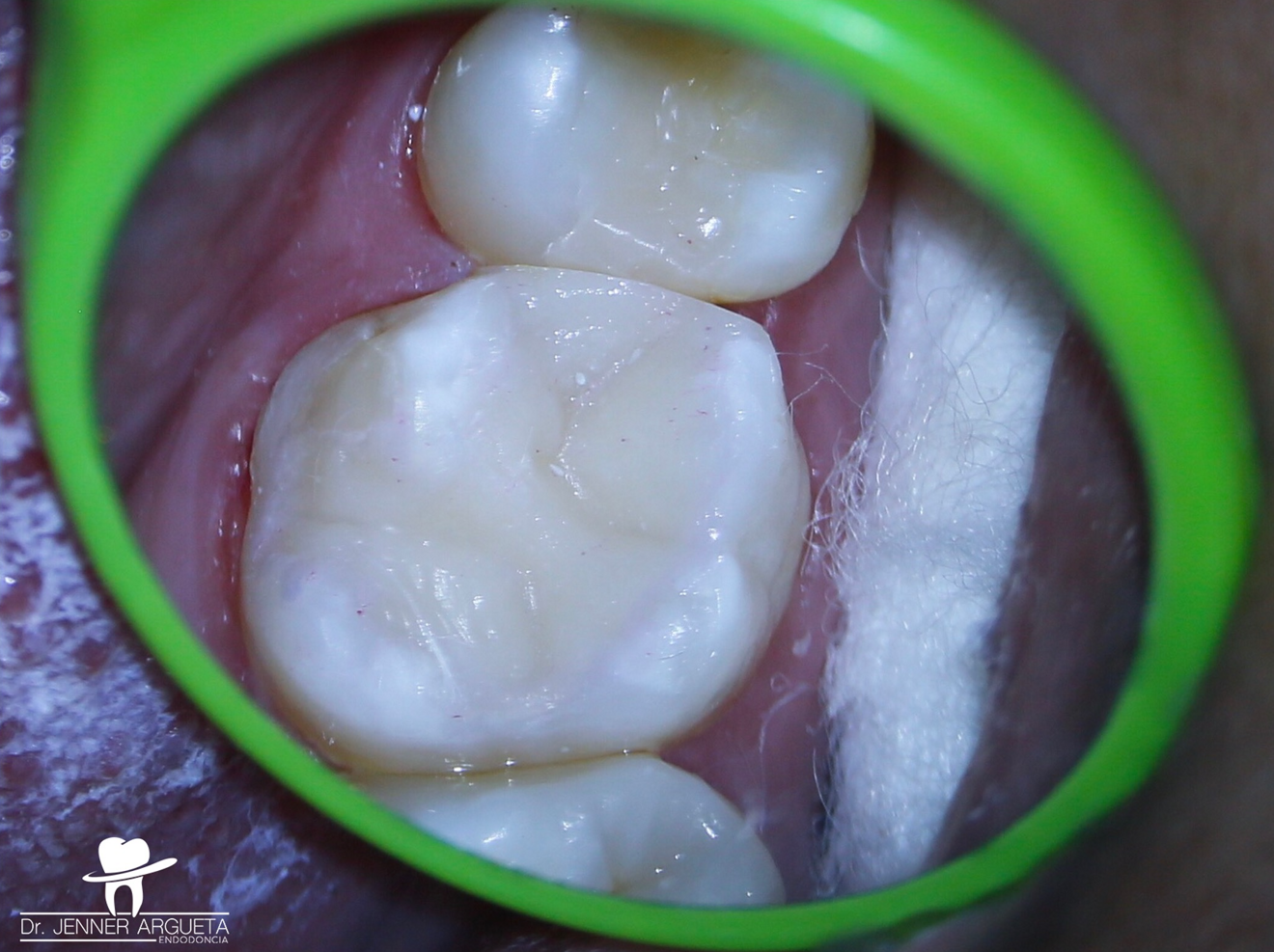 Fig. 8: The situation after the removal of the isolation and occlusal adjustment.