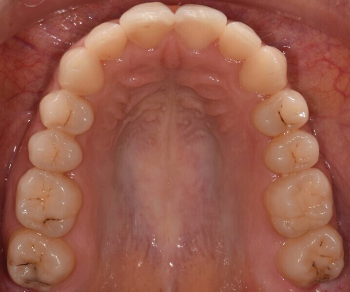 Fig. 6a : Photographie intraorale finale.