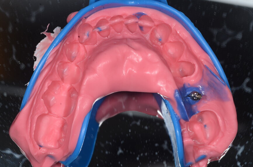 Fig. 10: Impression tray with impression post retained.