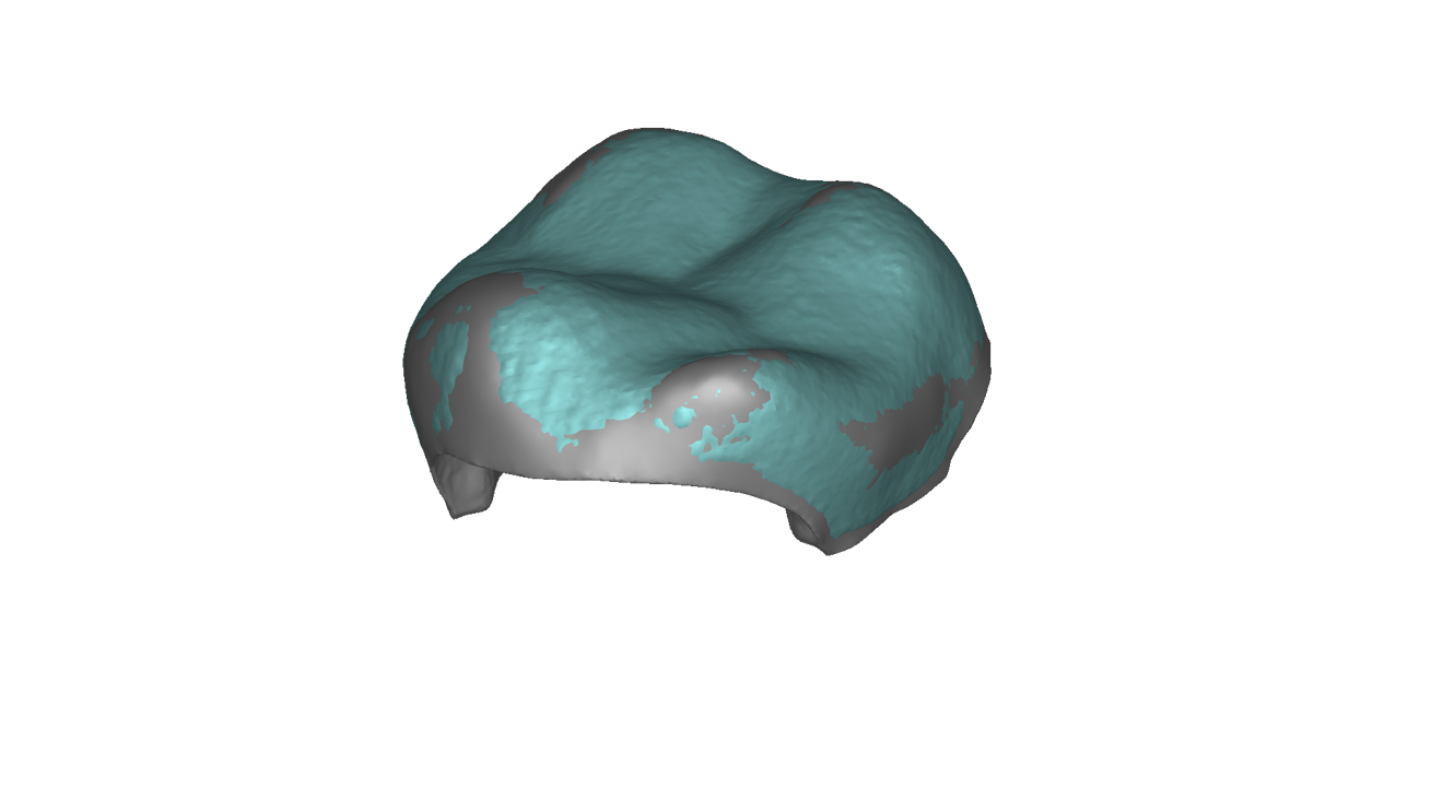 STL file overlaid on a reconstructed mesh in Artec Studio. 