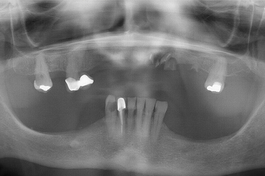 Fig. 27. Rx Pre-operatoria, Prótesis híbrida inmediata con 5 años de evolucion y Rx Control a los 5 años.