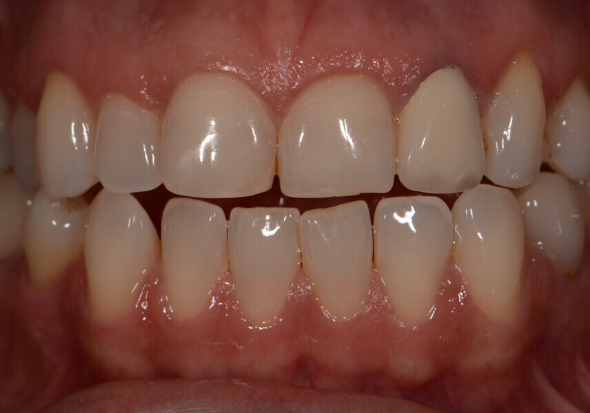 Fig. 6: Pre-op view of the restorative case.
