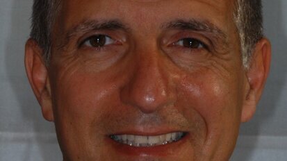 Impianti Direct Laser Metal Forming (DLMF): dalla ricerca alle applicazioni cliniche