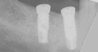 Horizontální augmentace