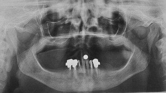Impianti short a carico immediato in grave atrofia mandibolare