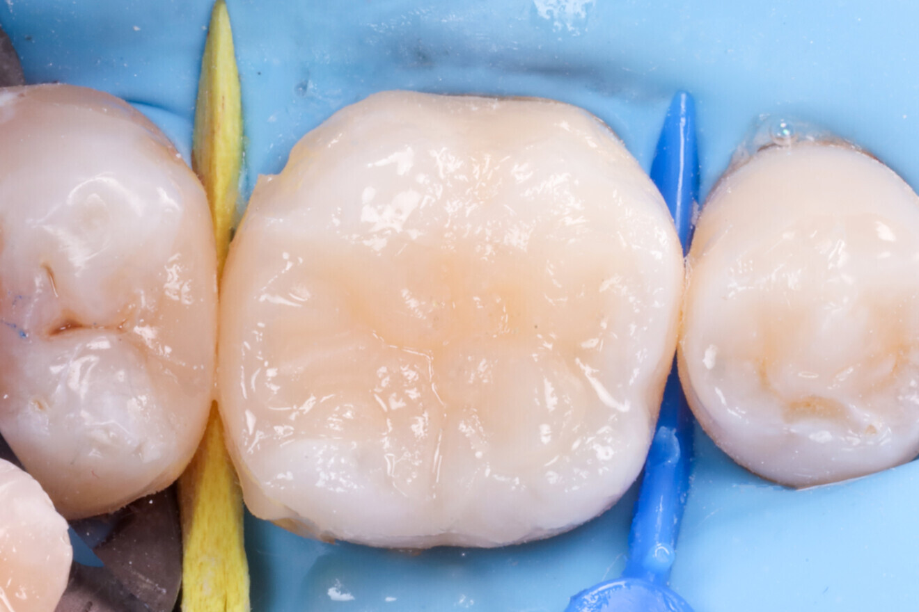 Fig. 24: Before excess removal.