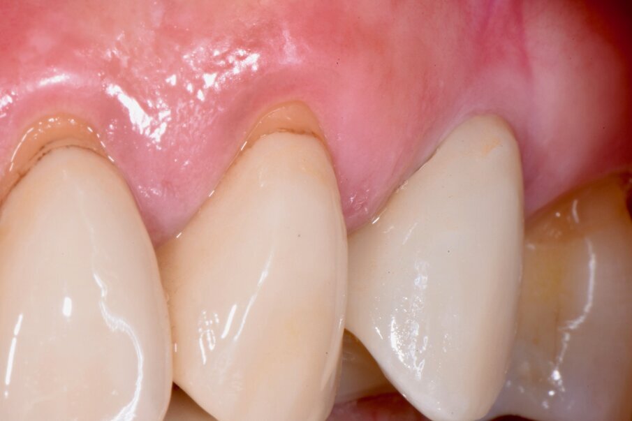 Fig. 6a - Caso clinico a due anni dalla finalizzazione implanto-protesica. 