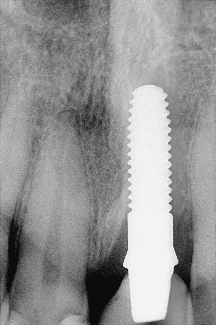 Fig. 6b  :
Situation postopératoire et radiographie après un an.
