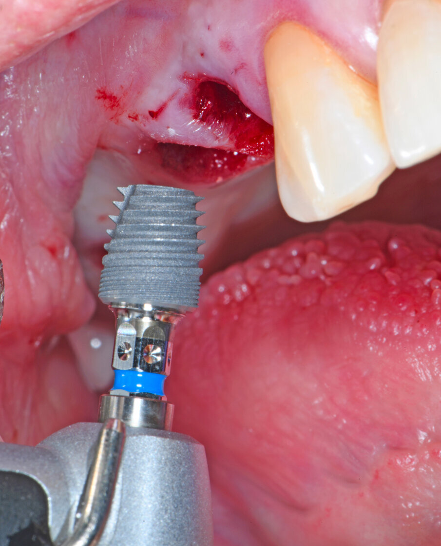 Obr. 2: Umístění implantátů.