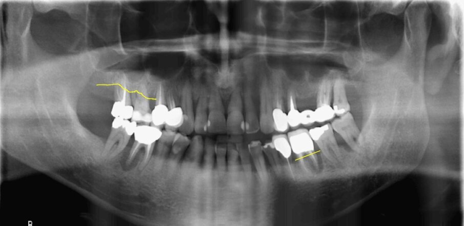 Fig. 2_Radiografia panoramica pre-operatoria di uno dei pazienti inclusi al tempo della chirurgia.