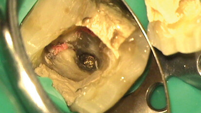 Ritrattamento di un molare inferiore