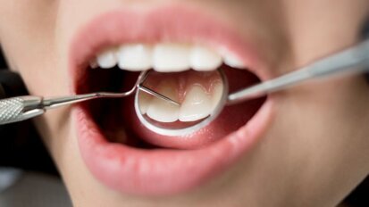 Wetenschappers ontwikkelen nieuw restauratiemateriaal