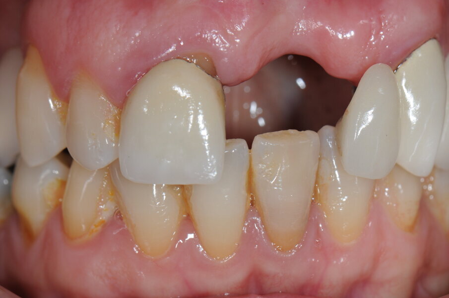 Fig. 2 - Visione frontale della zona edentula.