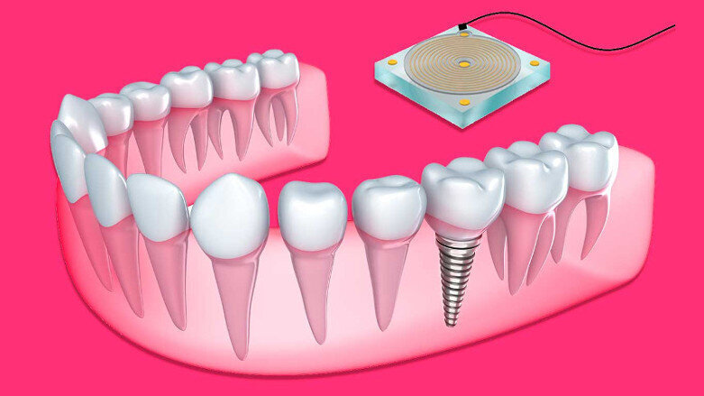 New sensor monitors bone growth around dental implants