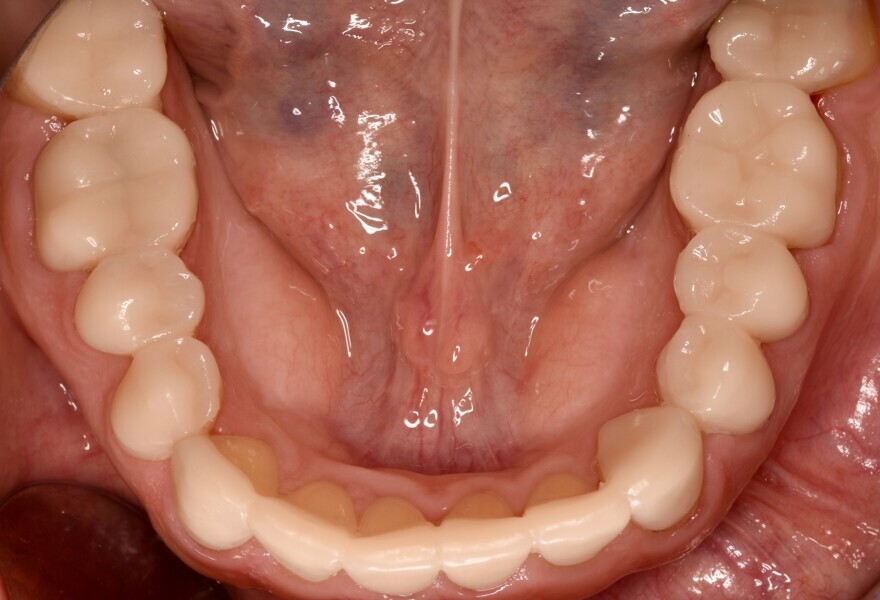 Fig. 11e: Temporarily cemented long-term provisional restorations. Occlusal view of the mandible.