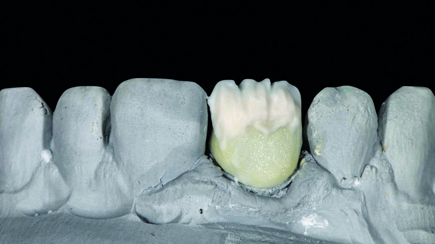 Fig. 6 : Application de la formule de caractérisation interne pour tenir lieu de dentine sur la région incisive. 
