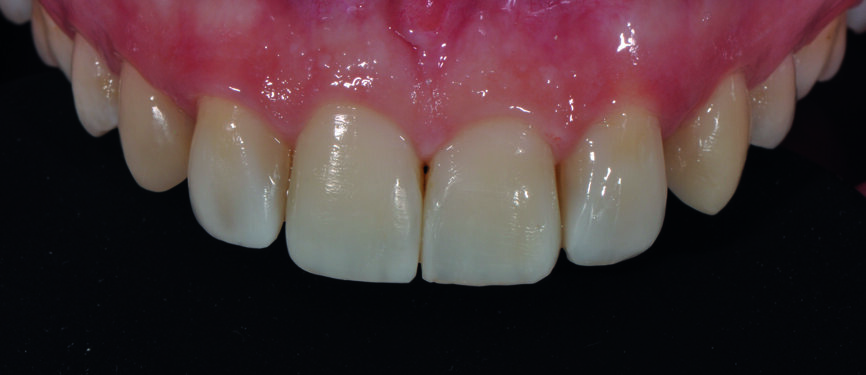 Fig. 3b : Gros plan du sourire après redéfinition de la forme. Il a été possible d’obtenir un résultat très plaisant avec les restaurations composites en technique directe