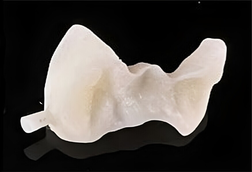 Fig. 13: 3D-printed inlay after removal of most of the supports, ready for finishing.