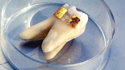 Nanosensor auf Zahnschmelz spürt Bakterien auf Nanosensor auf Zahnschmelz spürt Bakterien auf