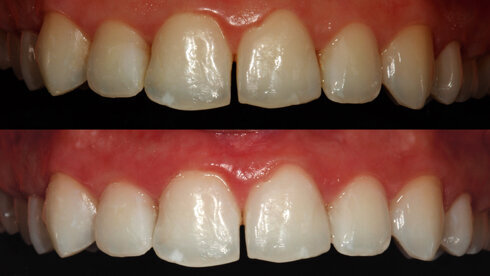 Srovnání situace před a po bělení