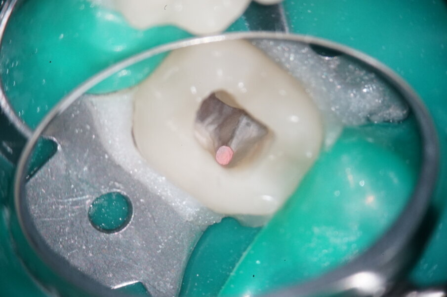 Fig. 12: Fillings in situ mesially.