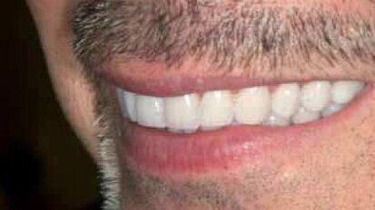 Od diagnostyki do protetyki – współpraca, komunikacja, realizacja.  II etap leczenia