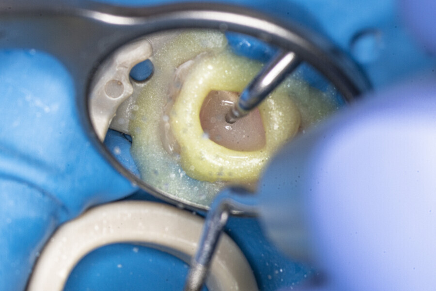Fig. 52: Activation of the sodium hypochlorite between the stages of ultrasonic preparation.