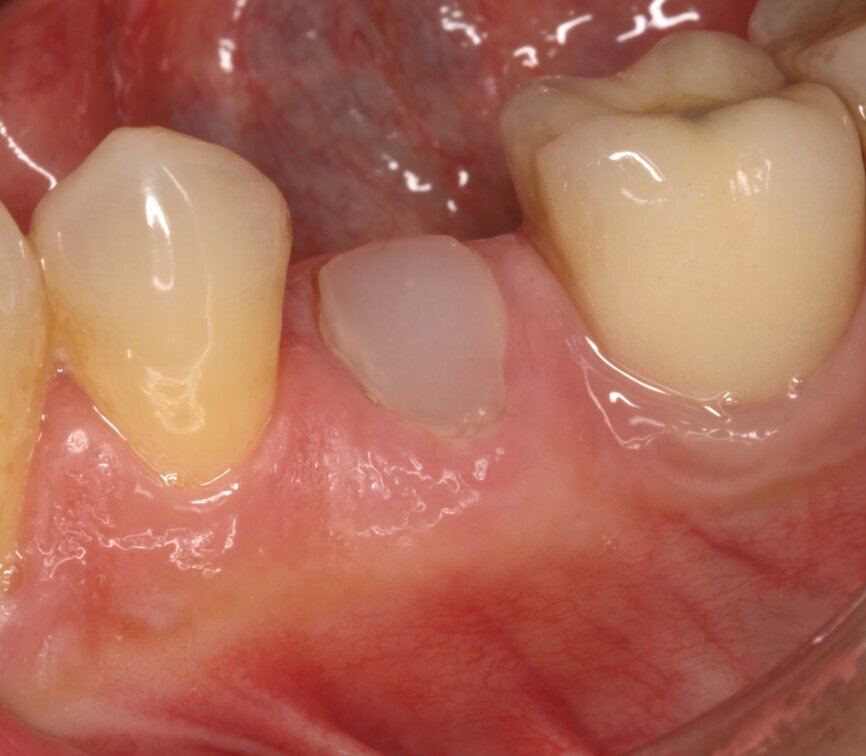 Fig. 1b: Initial situation: apical radiograph (a), intra-oral view (b) and CT scan (c).