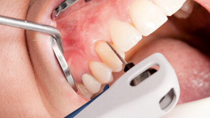 Ošetření pacientů s parodontitidou lineárním ultrazvukem Vector Paro