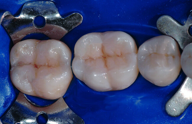 Fig. 34 : Apres rinçage de l’acide, et séchage de la dent, une fine couche d’adhésif est appliquée au niveau du joint dent/restauration. L’adhésif est polymerisé 