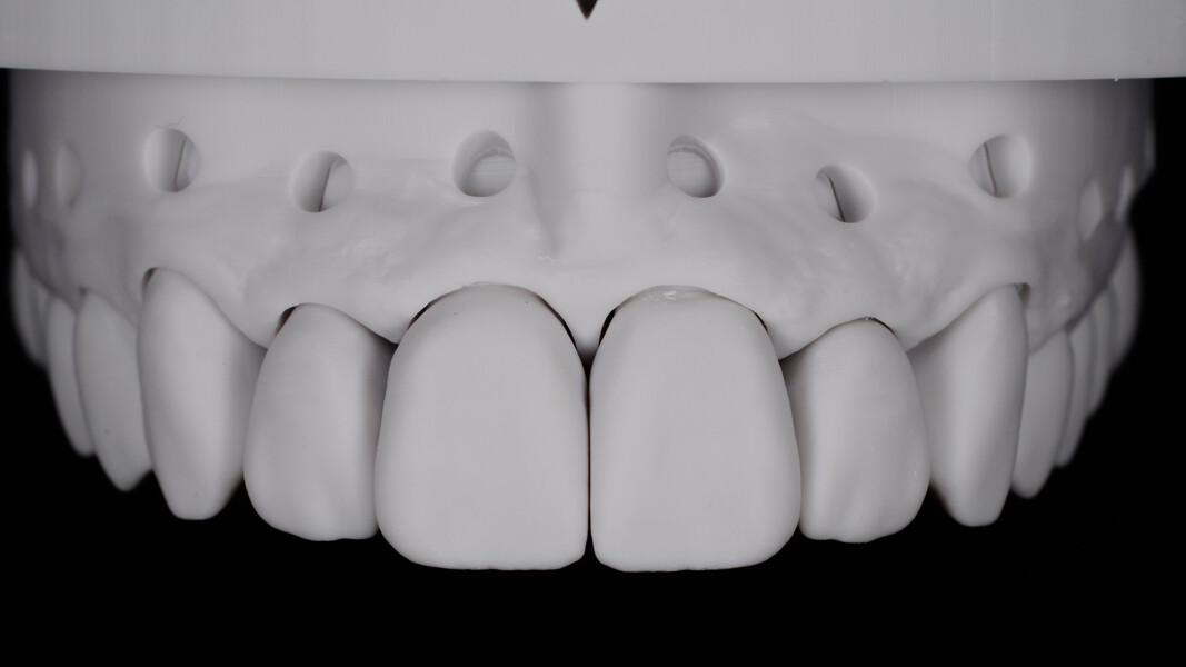 Fig. 12: Wax-up on the removable dies positioned on the model.