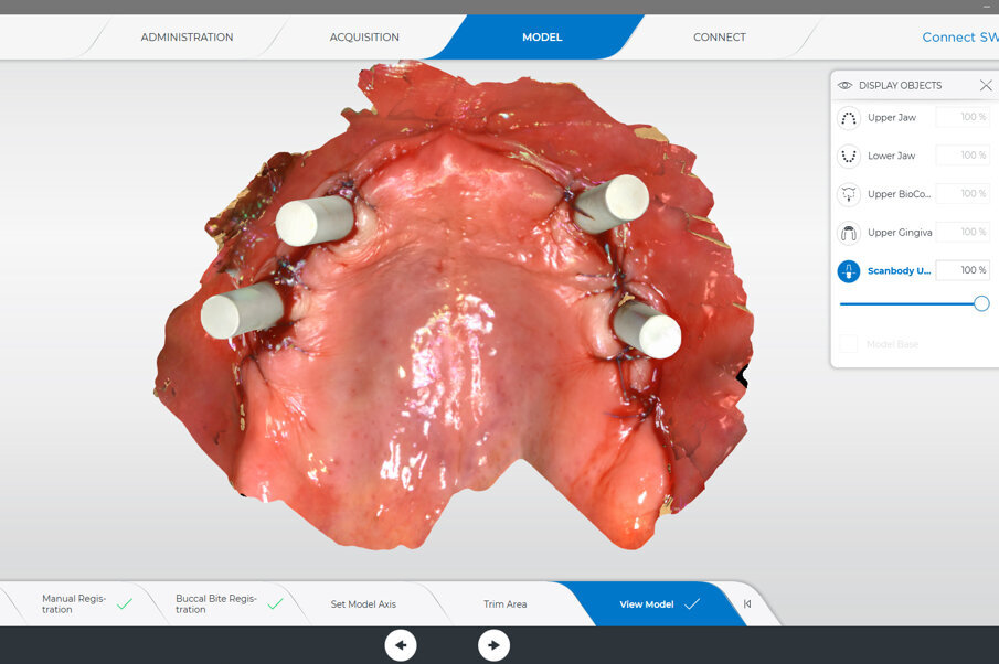 Fig. 11: Intra-oral scan of the abutment position, antagonists, provisional prosthesis and jaw relation for the manufacturing of the definitive prosthesis.