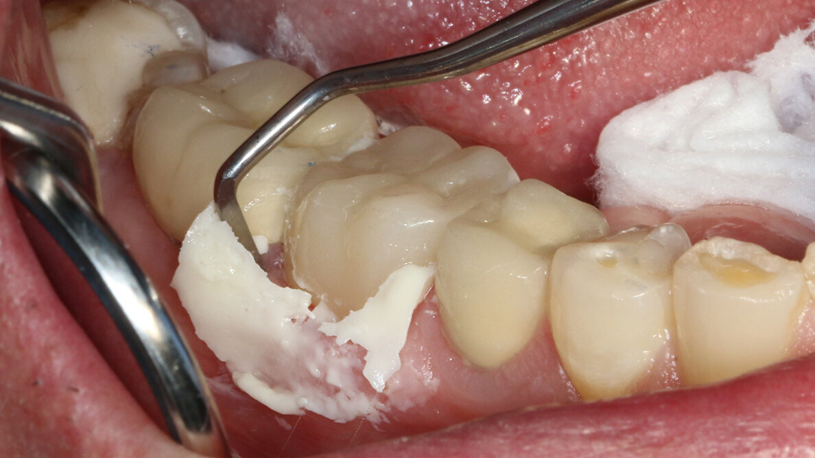 Benefits of bonding meet the simplicity of traditional cementing