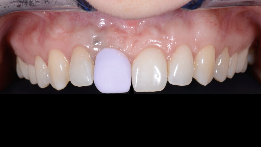 Fig. 33_Prova delle forme e verifica del grado di compressione dei tessuti molli vestibolari.