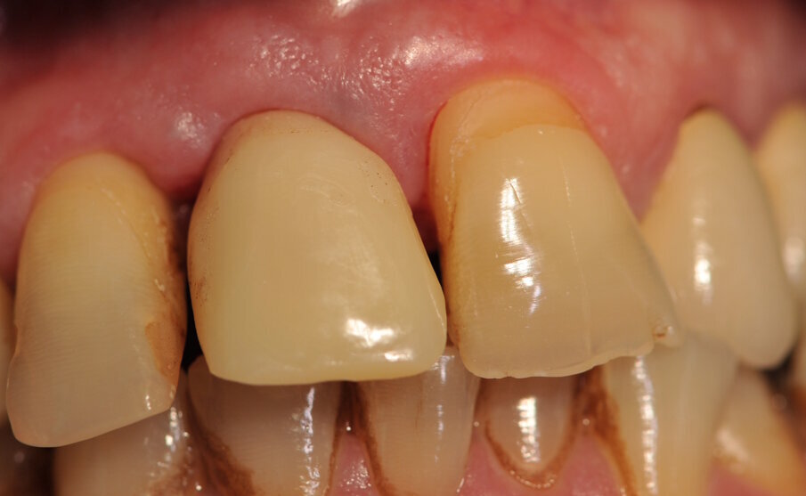Fig. 3_Situazione clinica con corona provvisoria a 9 giorni.