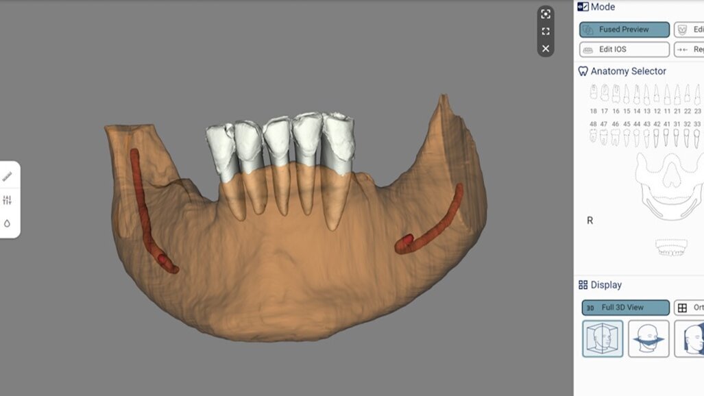 Изкуствен интелект и обогатена реалност при планиране на имплантологични лечения