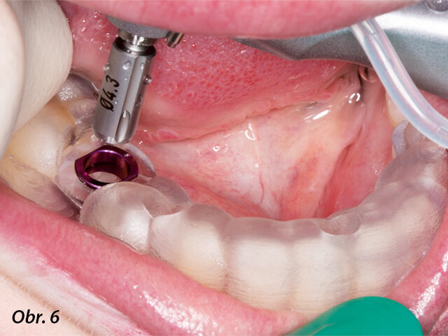 Chirurgická fáze zavádění implantátu byla provedena pomocí chirurgické šablony vytištěné na 3D tiskárně.