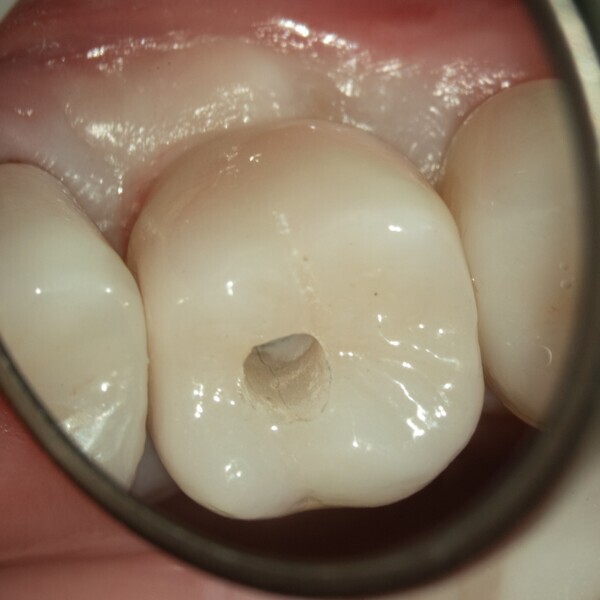 Fig. 2d:Palatal view of the marginal gingiva at prosthesis delivery. 
