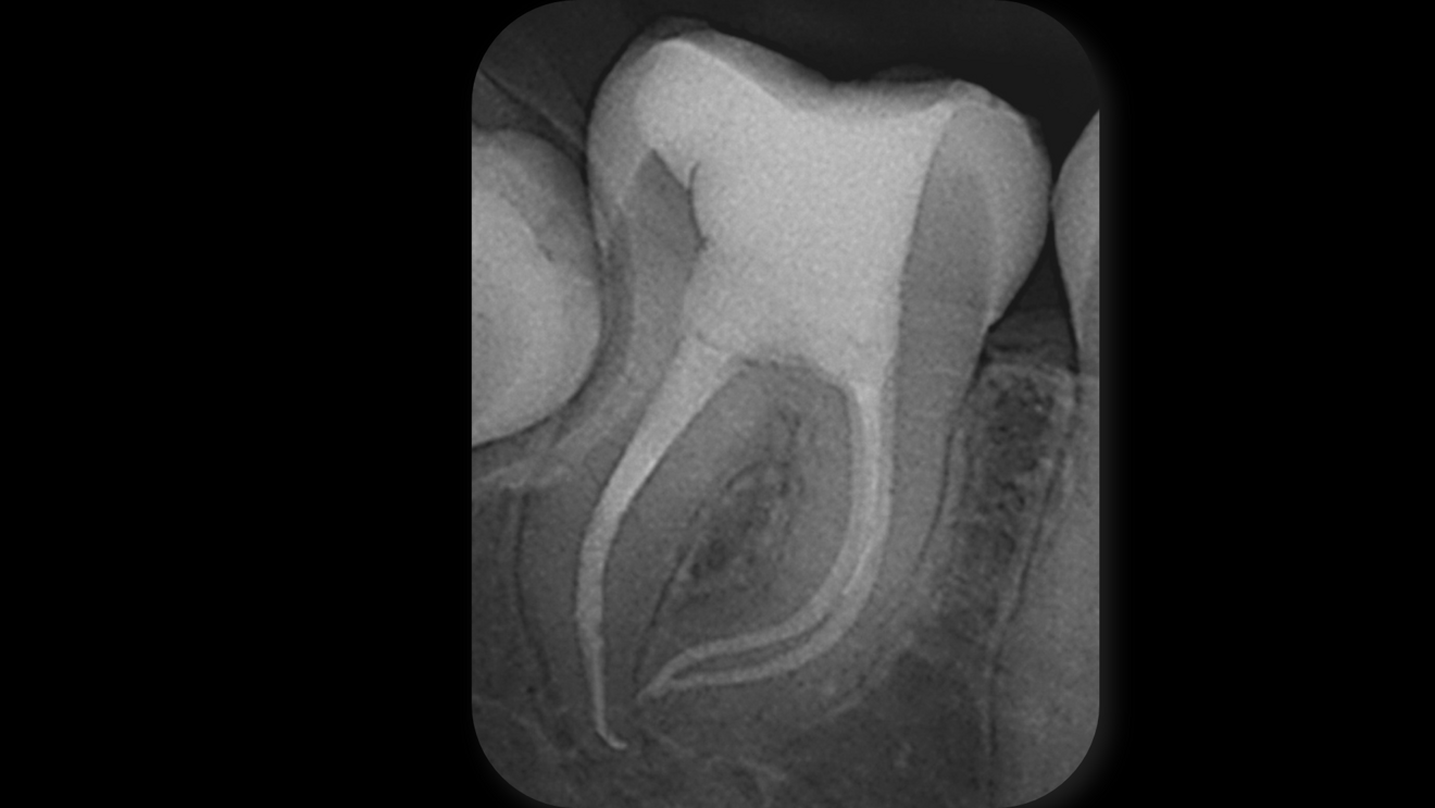 Fig. 4: Post-op radiograph of the mandibular right second molar showing dense obturation of all three curved canals and of a lateral canal in the distal root, indicating complete sealing of the canal system.