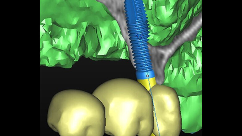 Navigovaná implantace do tenké čelisti
