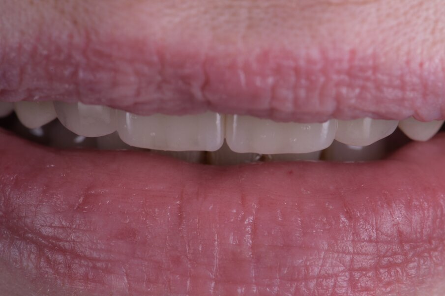 Fig. 49_A maggior ingrandimento notiamo la naturalezza delle labbra giustamente umettate segno di una fisiologia ritrovata.