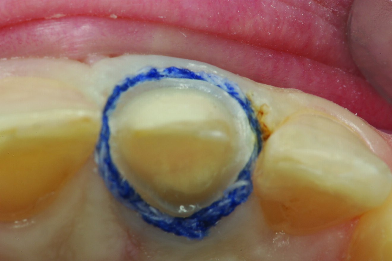 Fig. 13: Incisal view of the retracted preparation after the gingivoplasty had been completed.