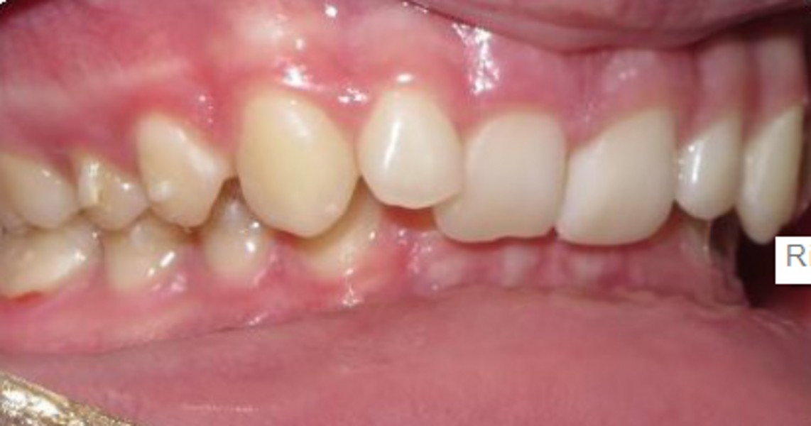 Fig. 17: After 12 months of unsuccessful distalisation.